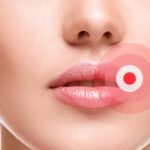 Was bei Lippenherpes hilft